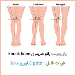 دانلود فایل پاورپوینت زانو ضربدری knock knee دانلود فایل پاورپوینت زانو ضربدری knock knee